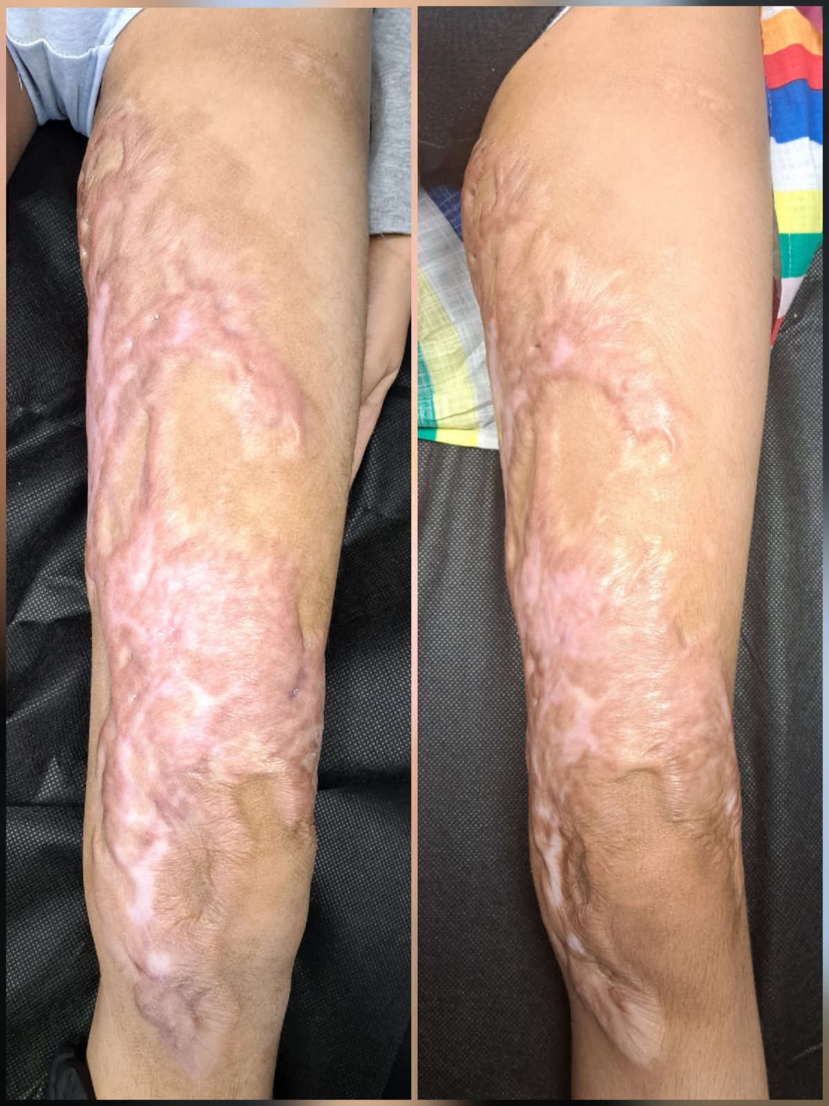 Terapia blizn